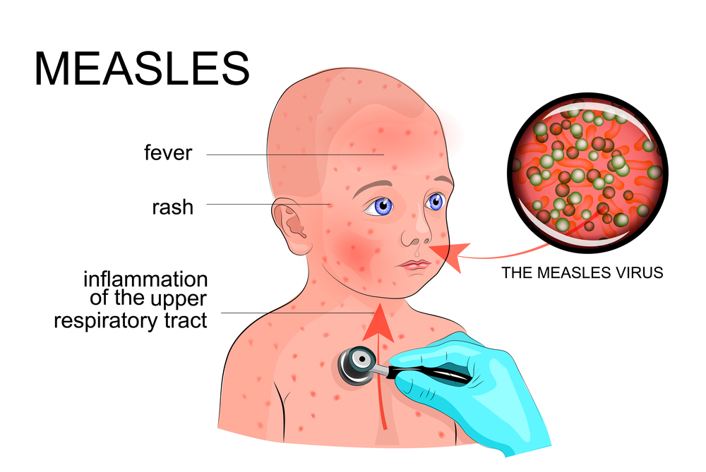 Measles in children - Baby Hints and Tips
