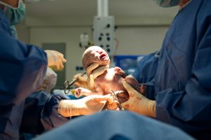 Caesarean - all you need to know