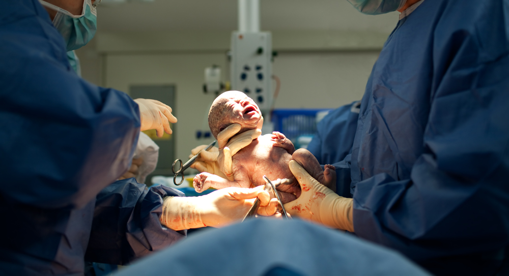 Caesarean - all you need to know