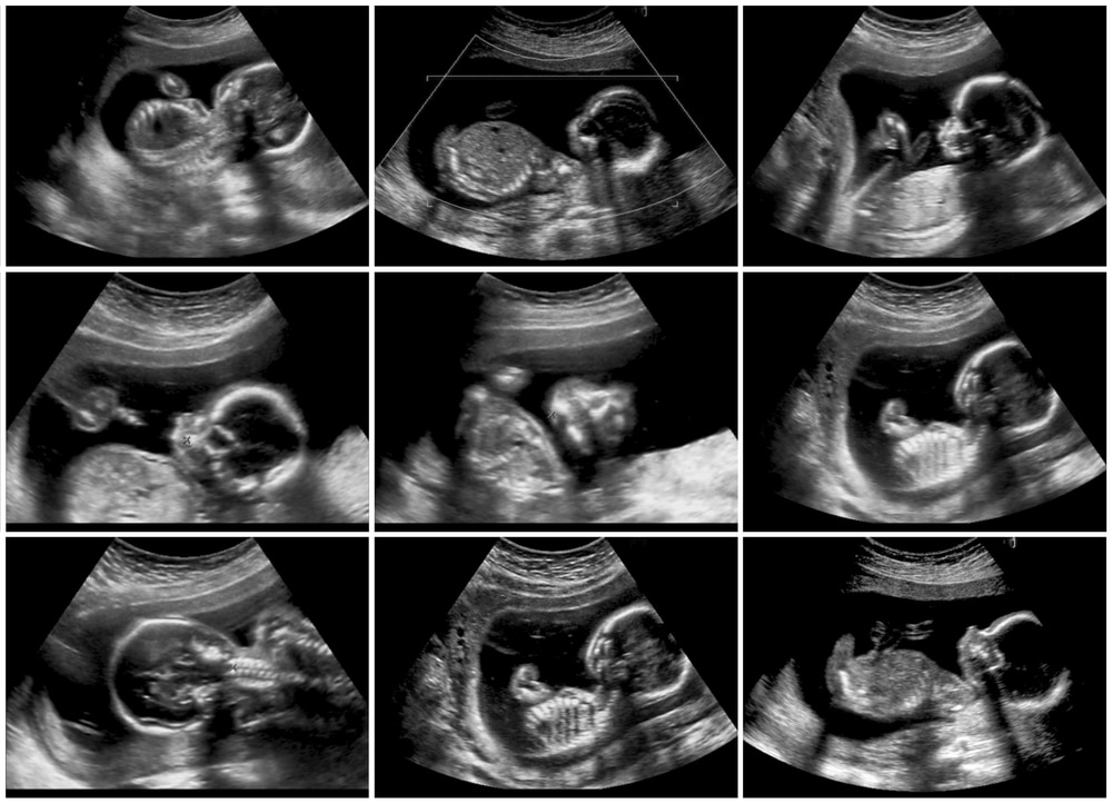 ultrasound in second trimester